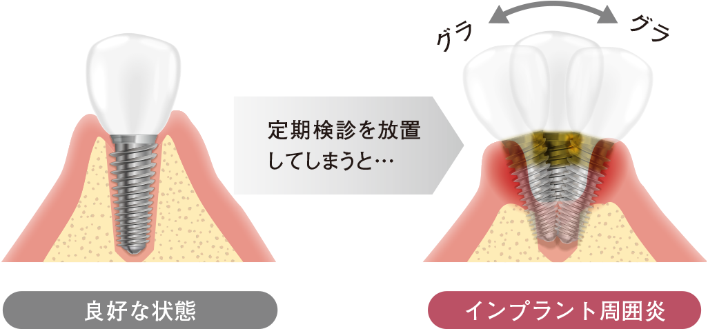 噛み続けるためには、歯周組織という歯を支える“土台”の強さが必要です。
