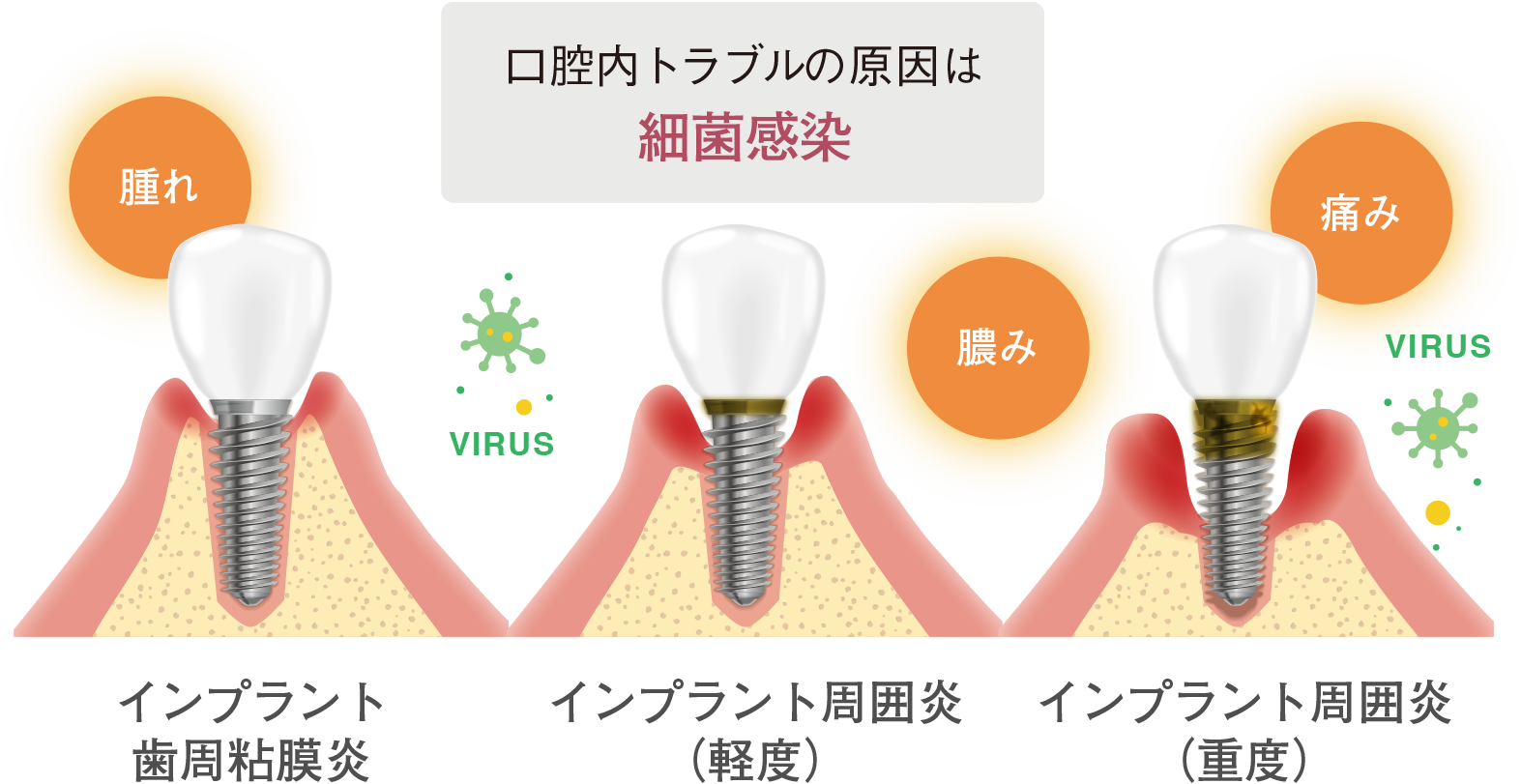 インプラントに必要なこと