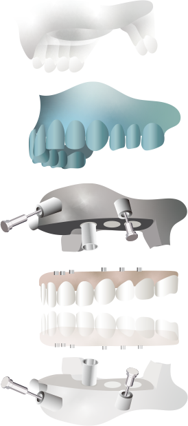 インプラント手術