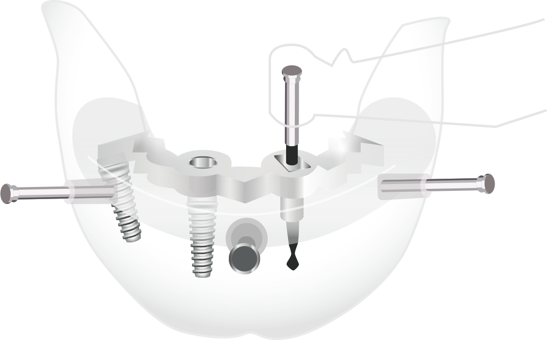 インプラント手術