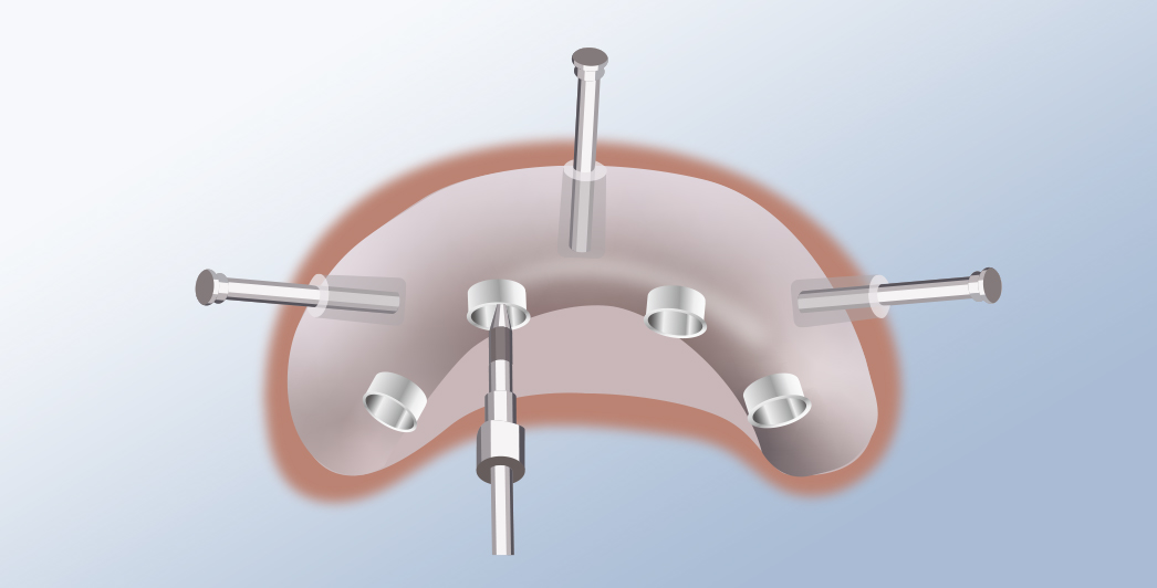 「オープントレー法」