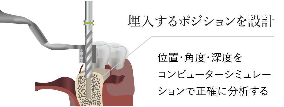 先端インプラント外科手術