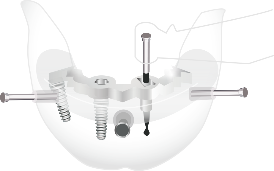 「オープントレー法」